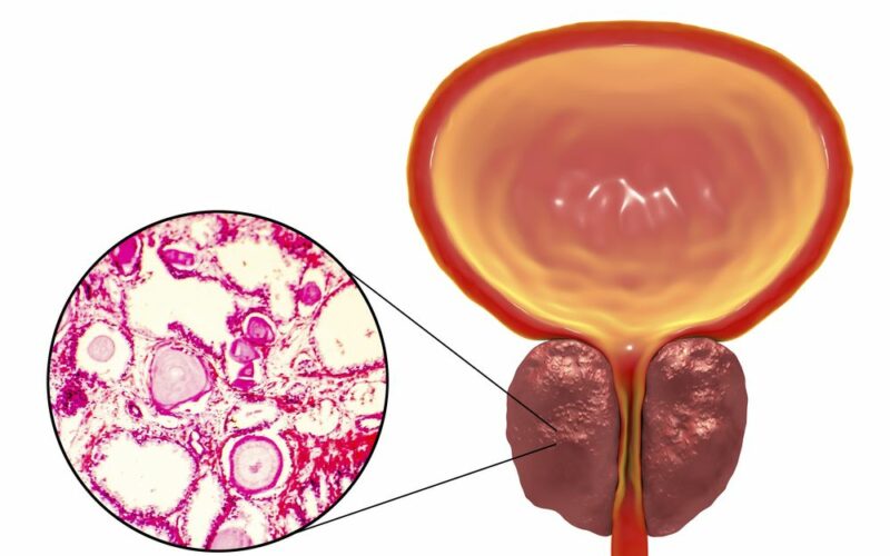 Zvětšená prostata